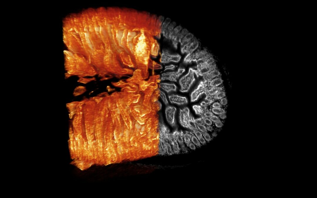 Microbiome Hopes For Cancer Therapies